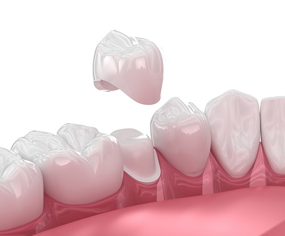 Illustration of dental crown being attached to tooth