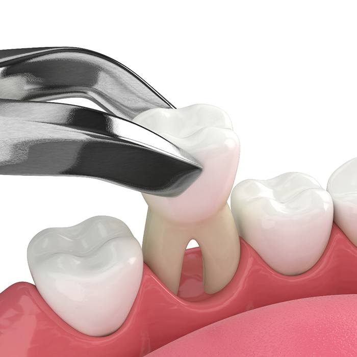 Illustration of a tooth extraction