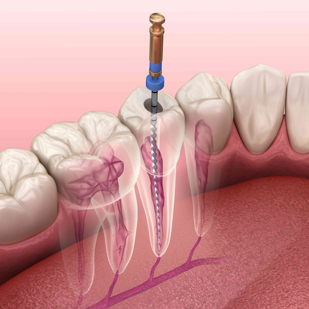 Digital illustration of root canal treatment