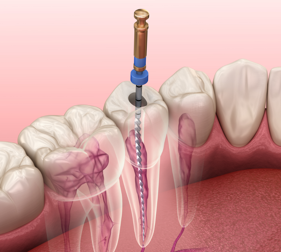 Illustration of a root canal cross section